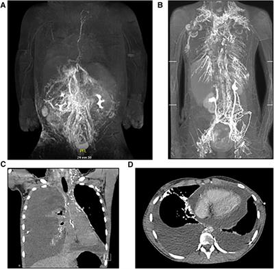 Microsurgical central lymphatic reconstruction—the role of thoracic duct lymphovenous anastomoses at different anatomical levels